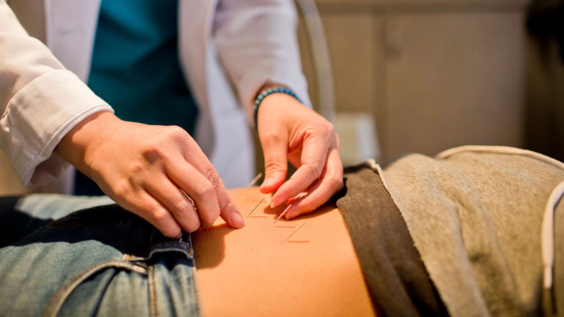 acupuncture